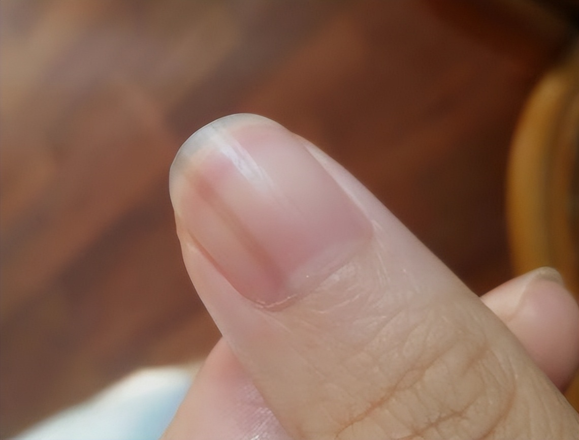 手指有竖纹是肝不好的表现吗,手指甲竖纹没有月牙是肝不好么