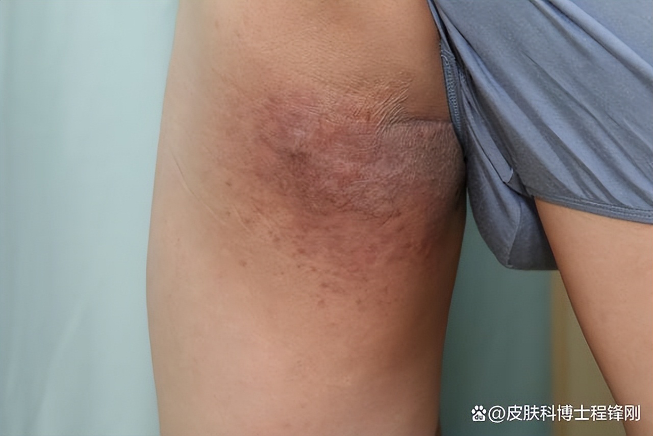 大腿两侧一小块红斑是什么皮肤病,大腿内侧一大片红癣