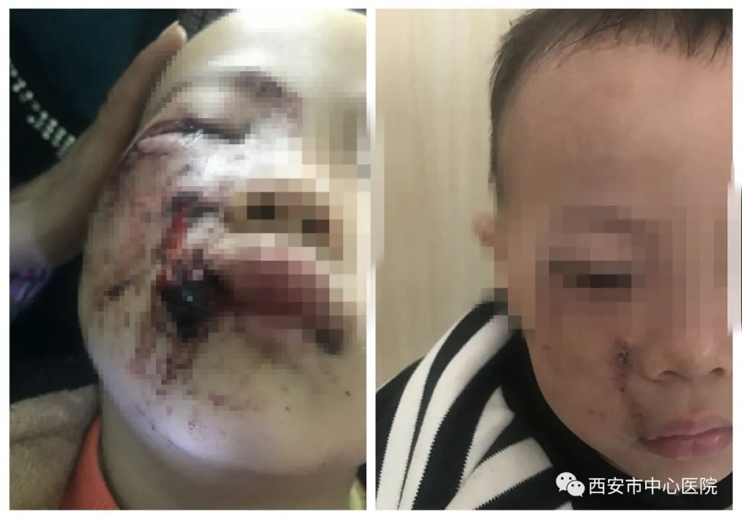 三岁男童遭狗咬伤后不幸离世,3岁孩子被狗咬伤后死亡