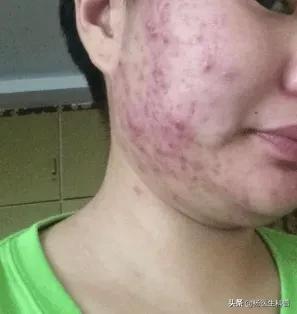 长青春痘怎么办什么办法可以消除,如何正确的祛除青春痘