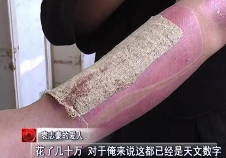 河南男子掉入油锅后来怎么样了,河南男子掉进油锅