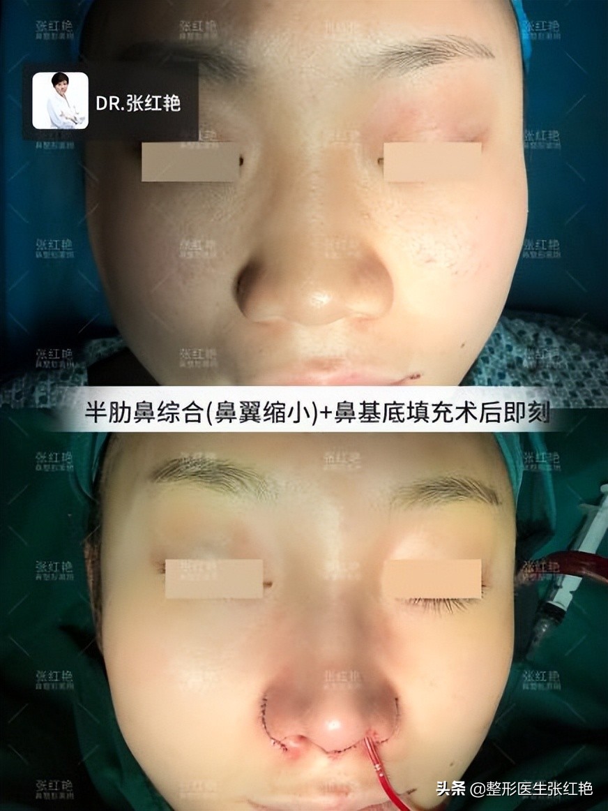 缩鼻翼怎么不留疤,缩鼻翼疤痕凸起