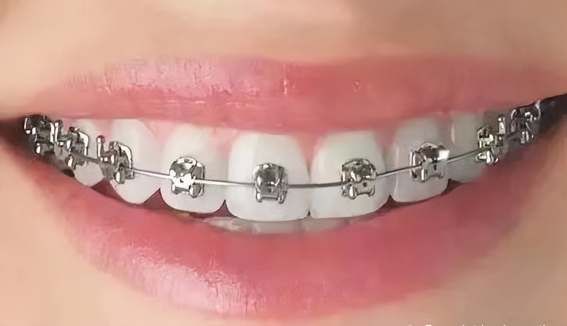 戴牙套会把牙齿戴黄?教你一个小妙招,轻松美白牙齿很简单!