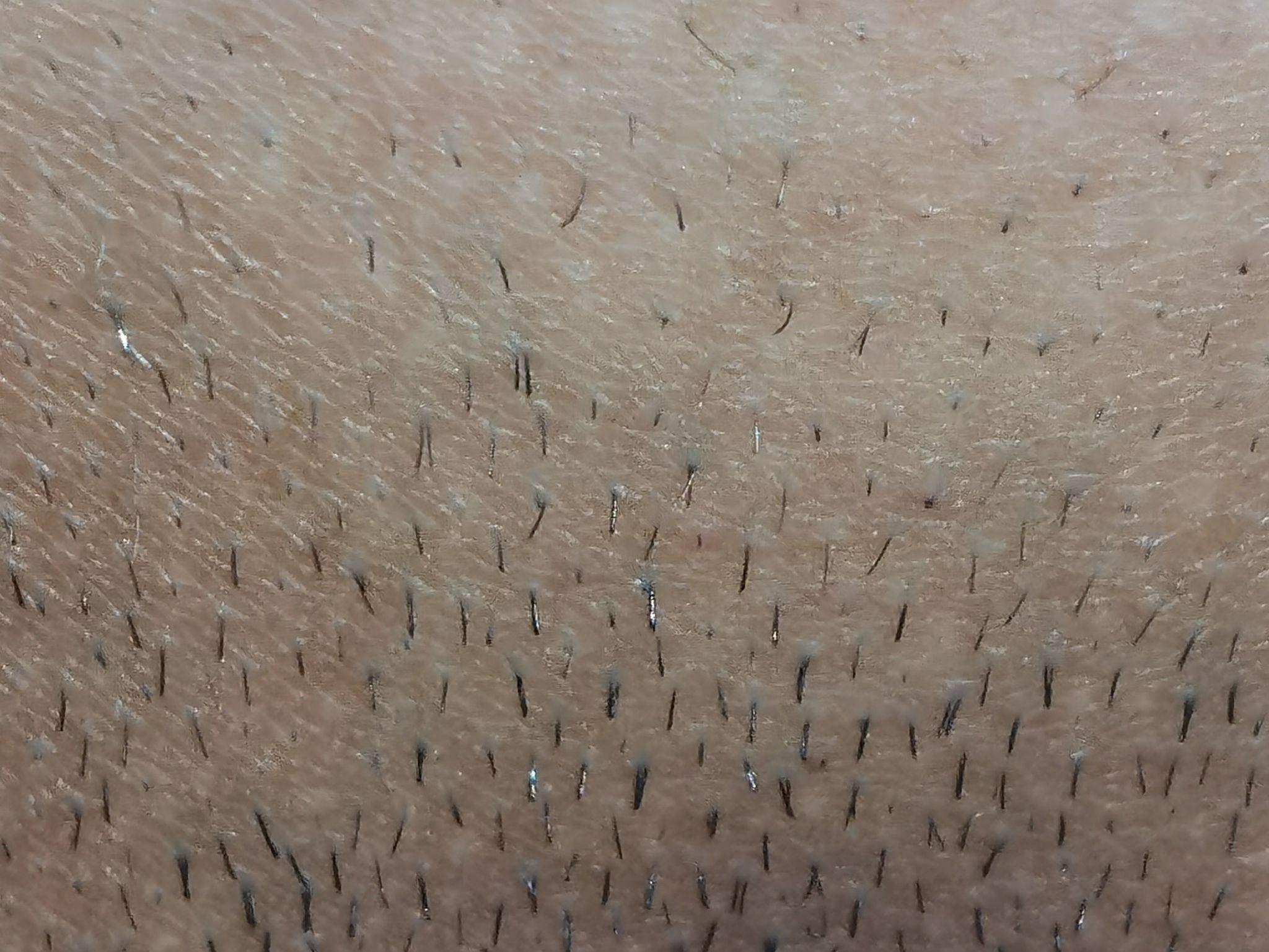 女性毛发容易掉落,什么原因会导致毛发脱落