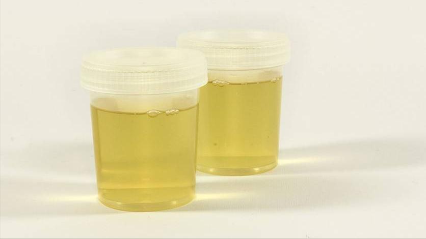 肾脏验血和彩超没问题尿有泡沫,尿里有泡沫是豆类惹的祸吗