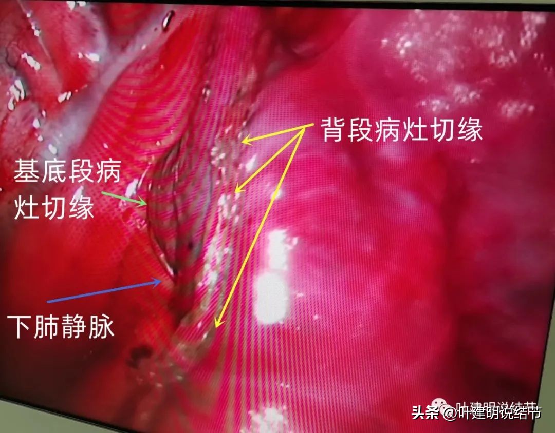 右下叶磨玻璃结节5*4,右下叶磨玻璃样结节多为炎性