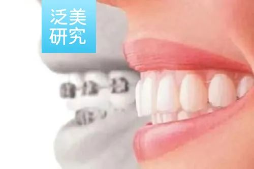 双寡头垄断市场优缺点,隐形正畸市场分析