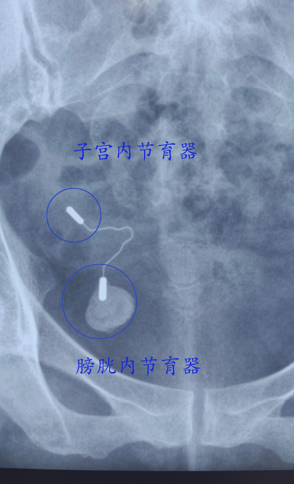 哈医大一院子宫附件切除手术,哈医大一院群力妇科