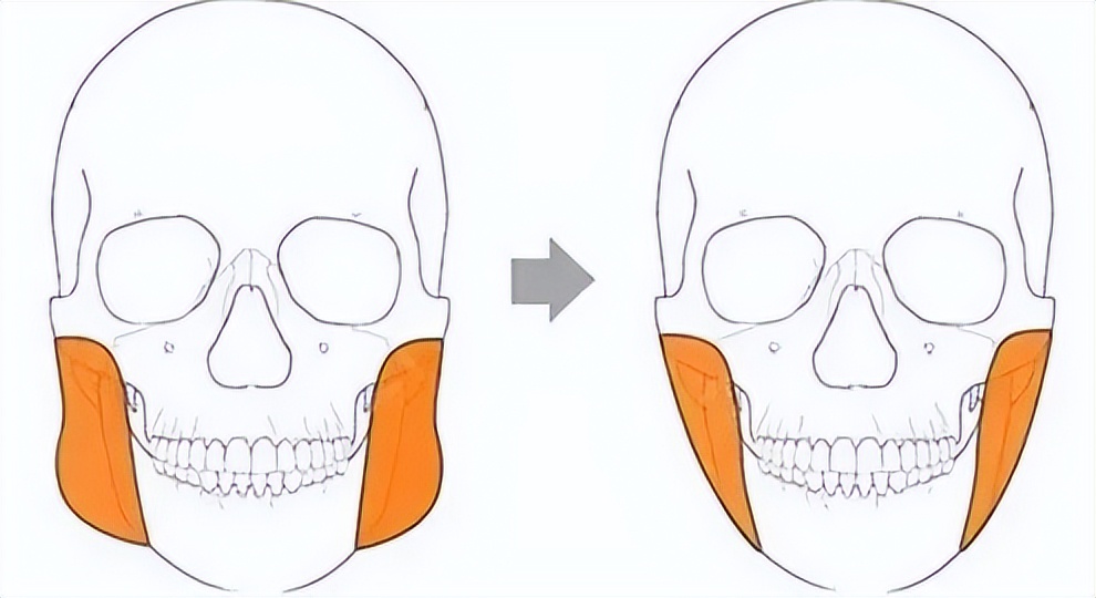 上海九院韦敏轮廓做得好吗,九院韦敏下颌角截骨案