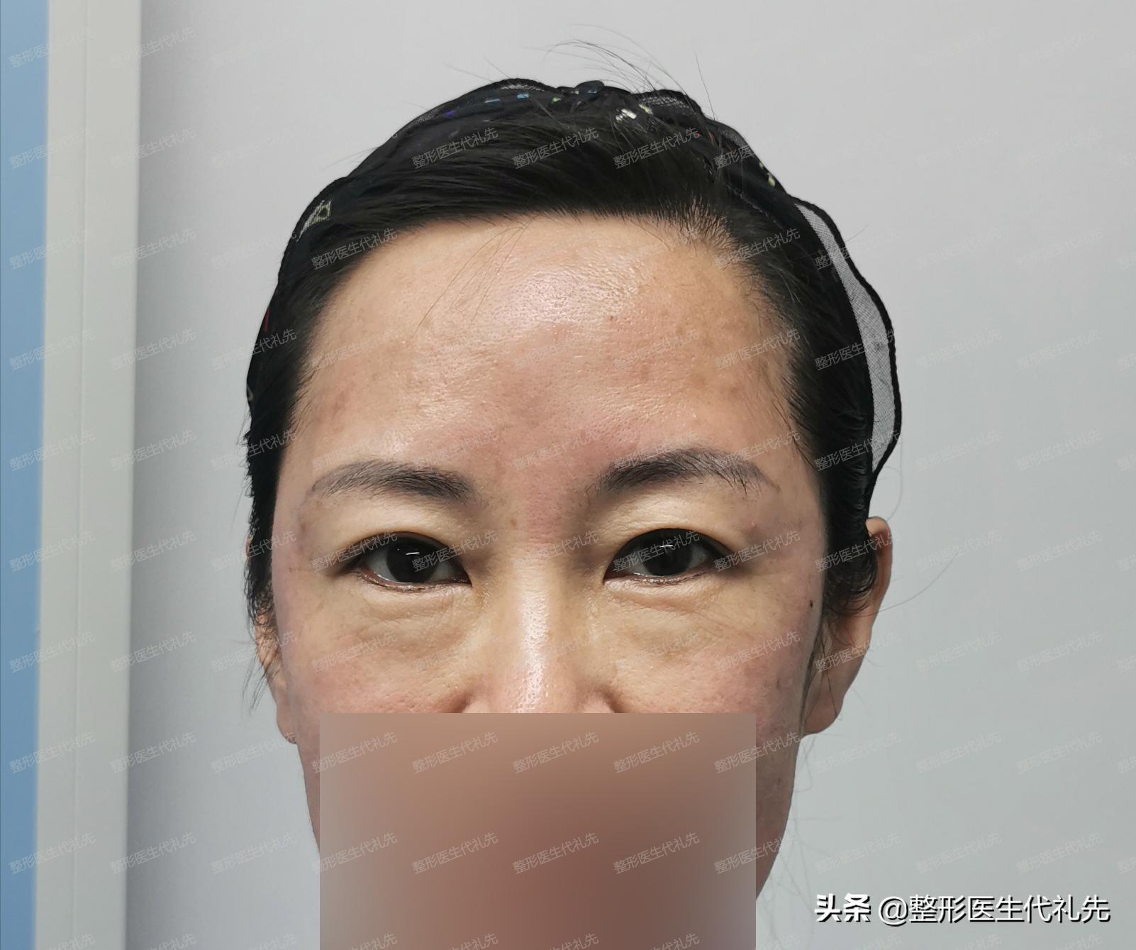 下眼袋下边的皱纹叫什么,下眼袋有皱纹图片