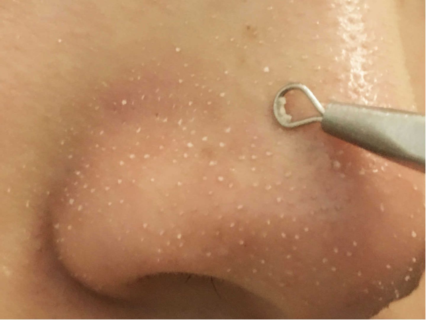 上完粉底液鼻子上有白点,涂粉底液后毛孔有白点点