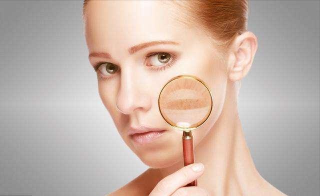 褐青色斑药物治疗,治疗褐斑的最佳方法