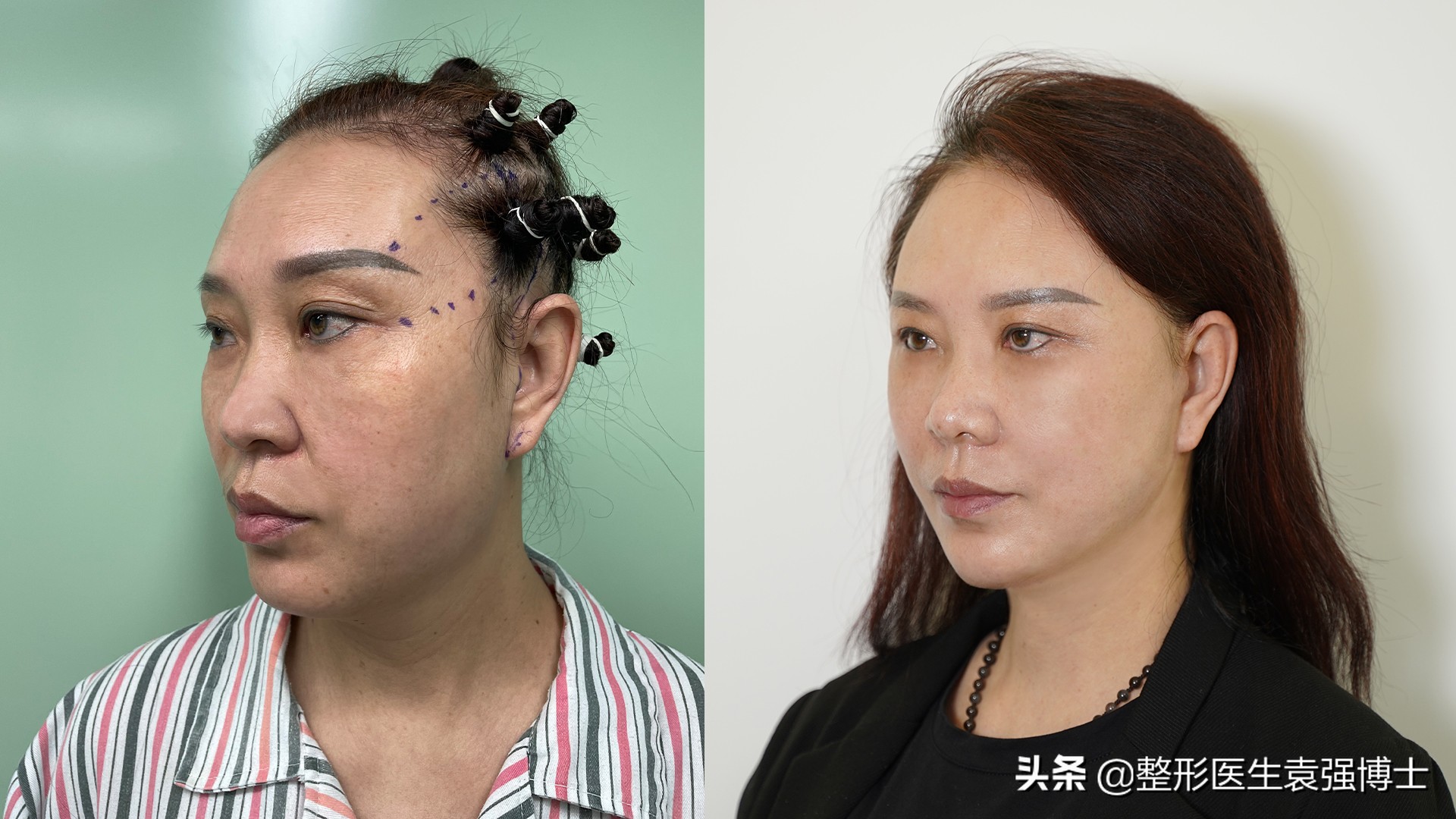 小拉皮是去除法令纹最好的方法,法令纹可以通过拉皮消除吗