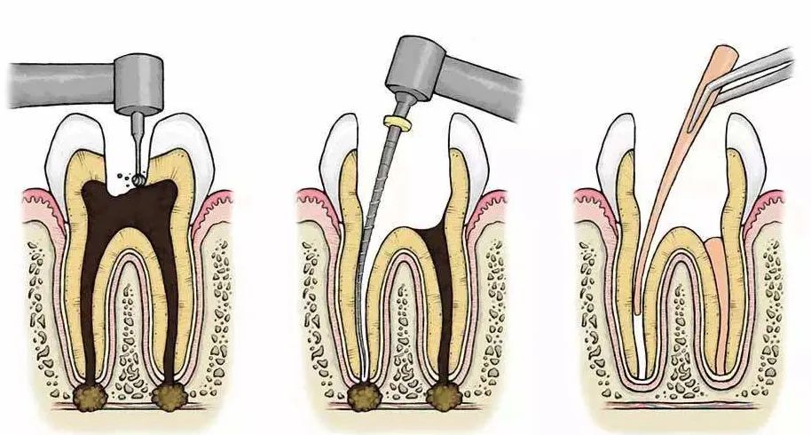 杀死牙神经后牙齿还能活多久,杀死牙神经牙能维持多久