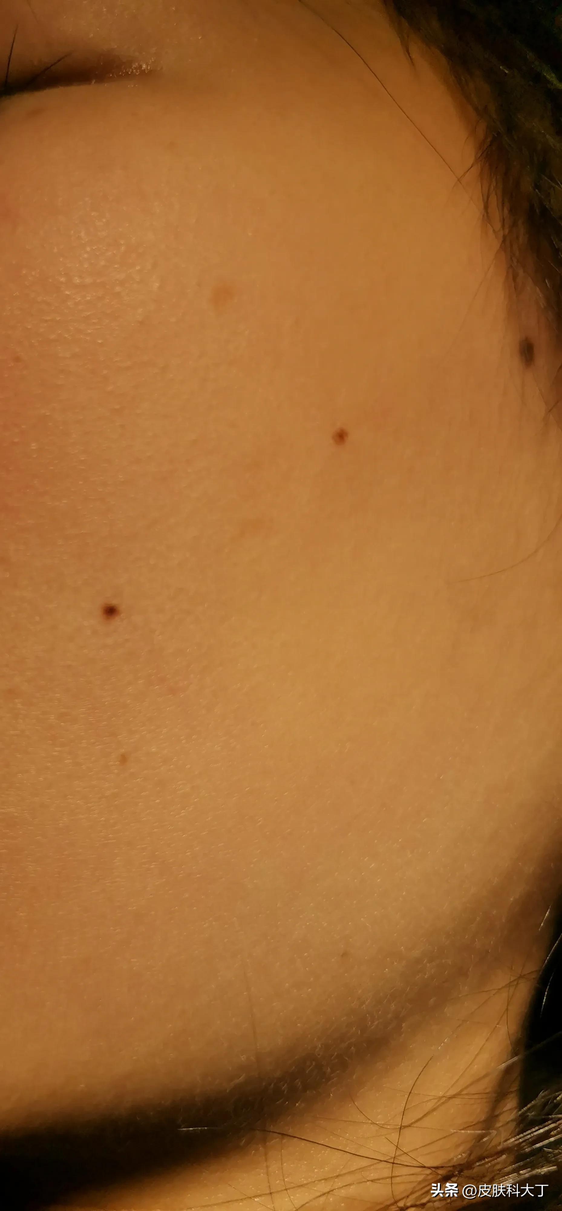 不要随便点痣的图片,不要轻易去痣