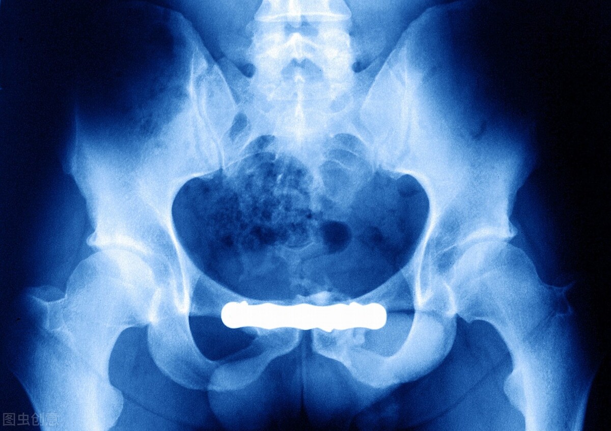 股骨头坏死是怎么回事后果是什么,股骨头坏死通常是什么原因导致的