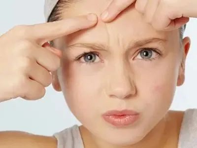 治痘过程中为什么频繁爆痘,战痘最快最有效方法是什么