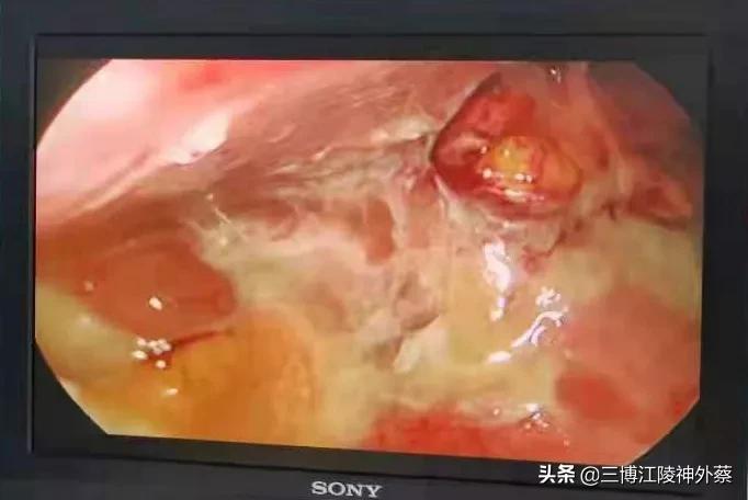 卵巢囊肿蒂扭转不能超过多长时间,左下腹隐痛卵巢囊肿