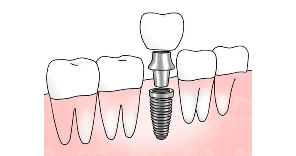 种植牙材料诺贝尔怎么样,瑞士诺贝尔高端种植牙