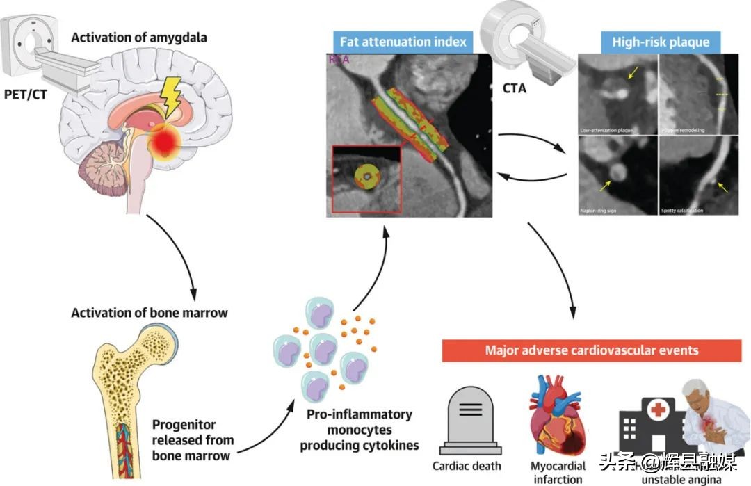 心梗生气容易猝死,心梗猝死跟心情生气激动有关系吗