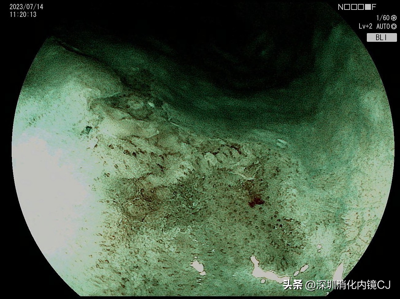69岁及时发现食管癌，内镜下微创根治，避免了外科开胸手术
