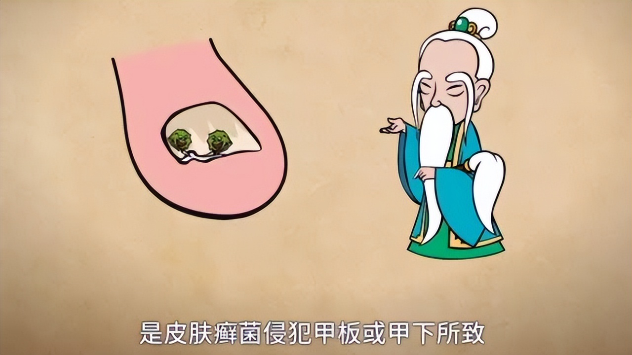 真菌性皮肤病—甲真菌病(灰指甲)