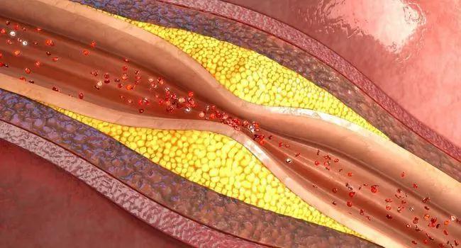 发现动脉硬化还能活多久,发现血管斑块是不是就是脑梗了