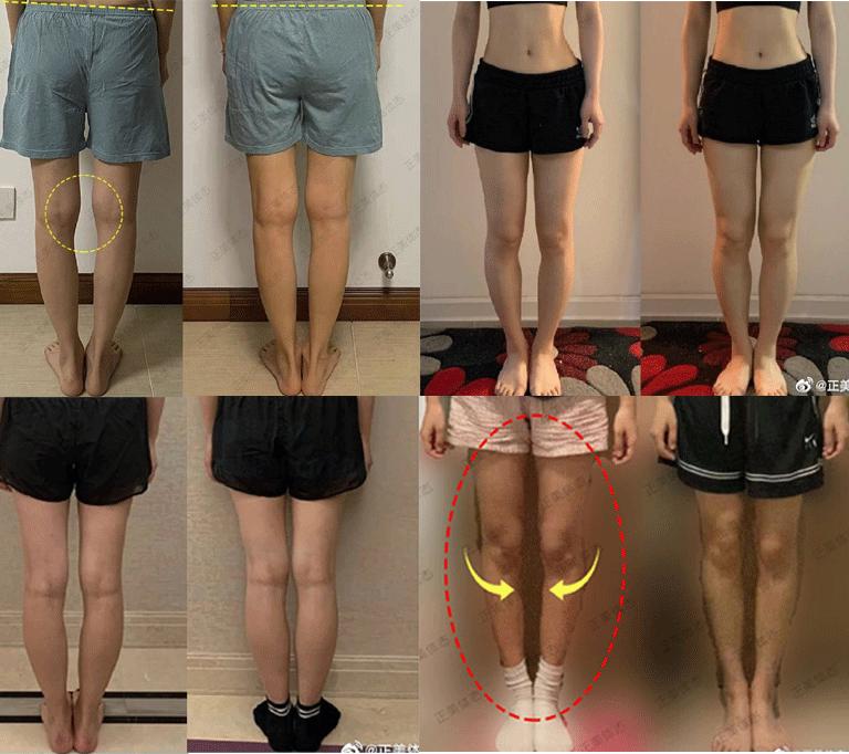 一周矫正腿型,一周改善o型腿学生党
