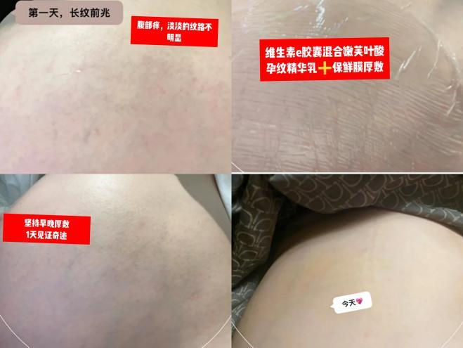 怀孕期间长了妊娠纹怎么补救,怀孕长妊娠纹怎么消除