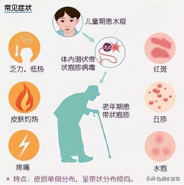 得带状疱疹的人会感染新冠病毒吗,新冠病毒与带状疱疹病毒有关系吗