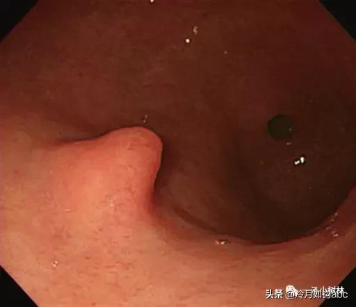 话说息肉：天生我才必有用，身体拒绝“休息之肉”