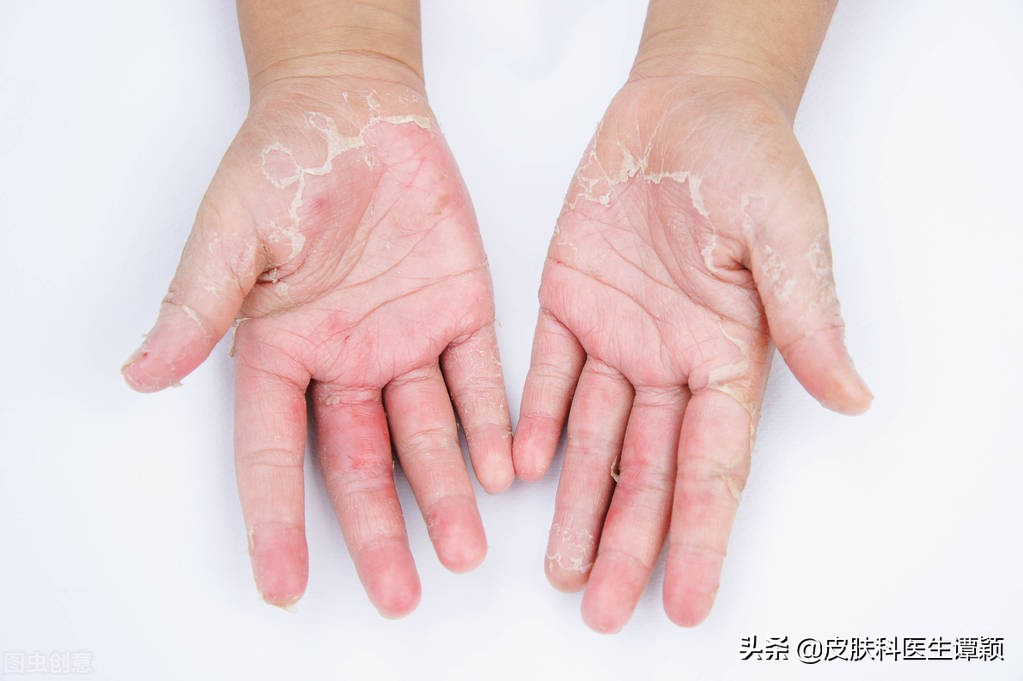 皮肤科汗疱疹真菌感染,皮肤科有关汗疱疹治疗