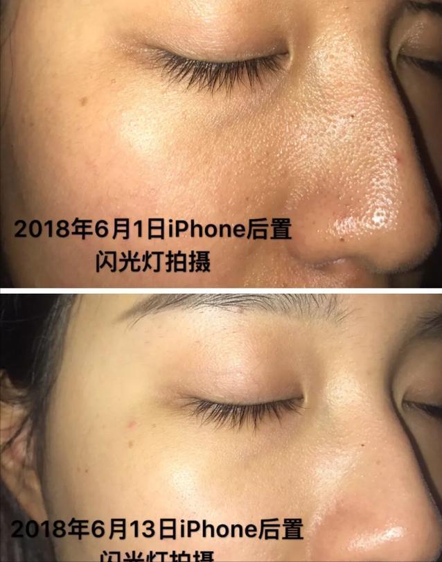 泰国女子打6年美白针六胜肽,女子打美白针后身患多病