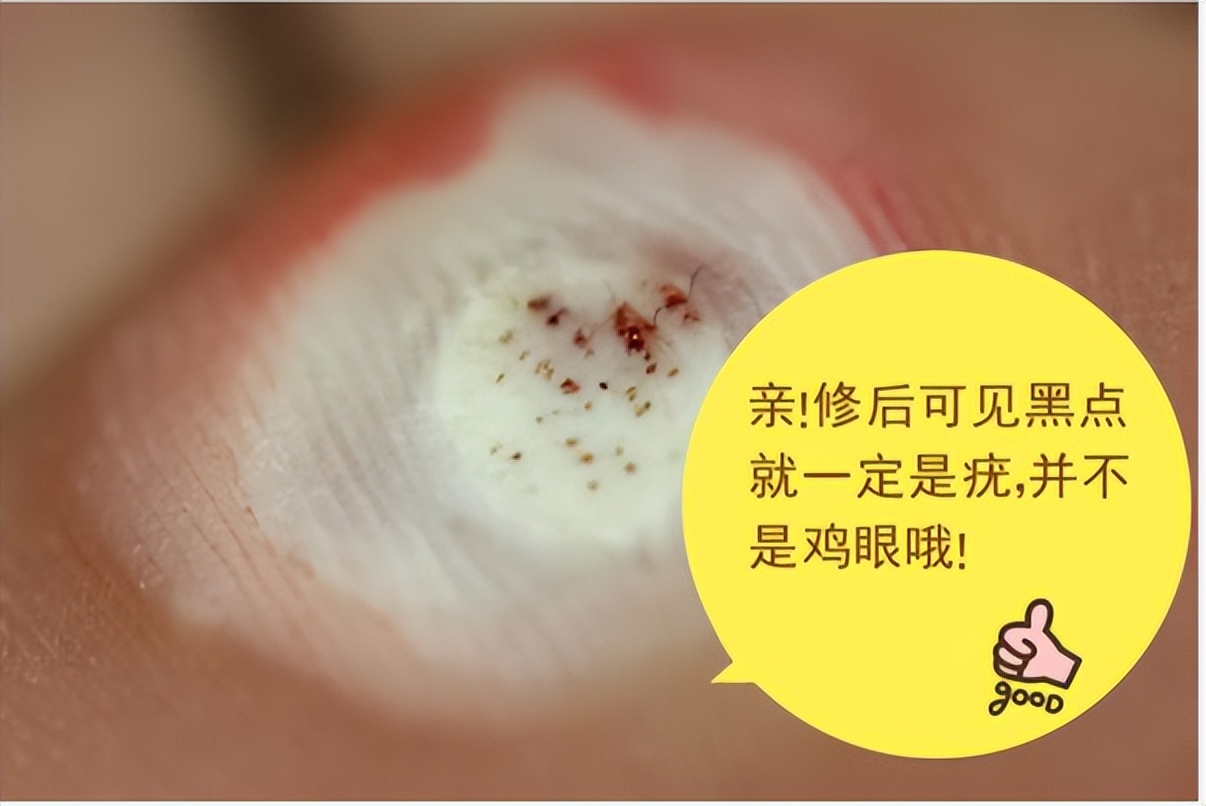 鸡眼瘊子和跖疣的区别,鸡眼跖疣傻傻分不清楚