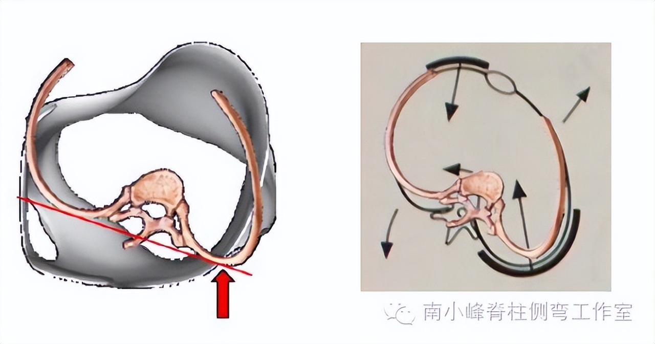 小孩脊柱侧弯恶化怎么治,脊柱侧弯多少度会形成剃刀背