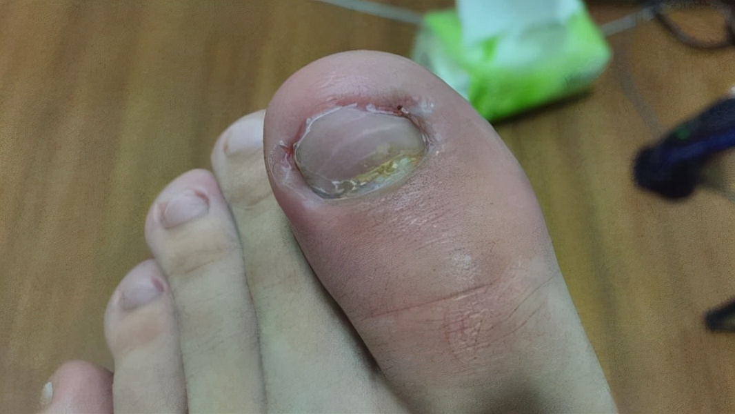 十岁孩子指甲上有竖纹是怎么回事,手指甲出现竖纹是身体哪里的原因