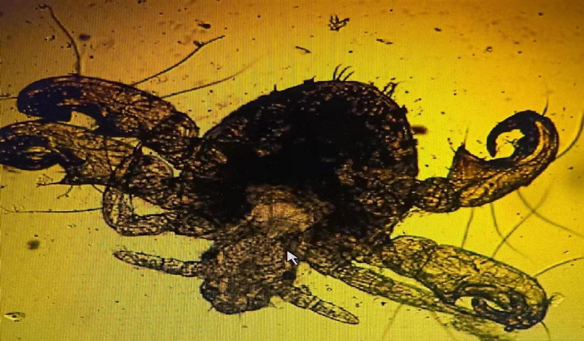 男子腹部痒，医生用镊子夹出12只阴虱！原来阴虱有这3个传播途径