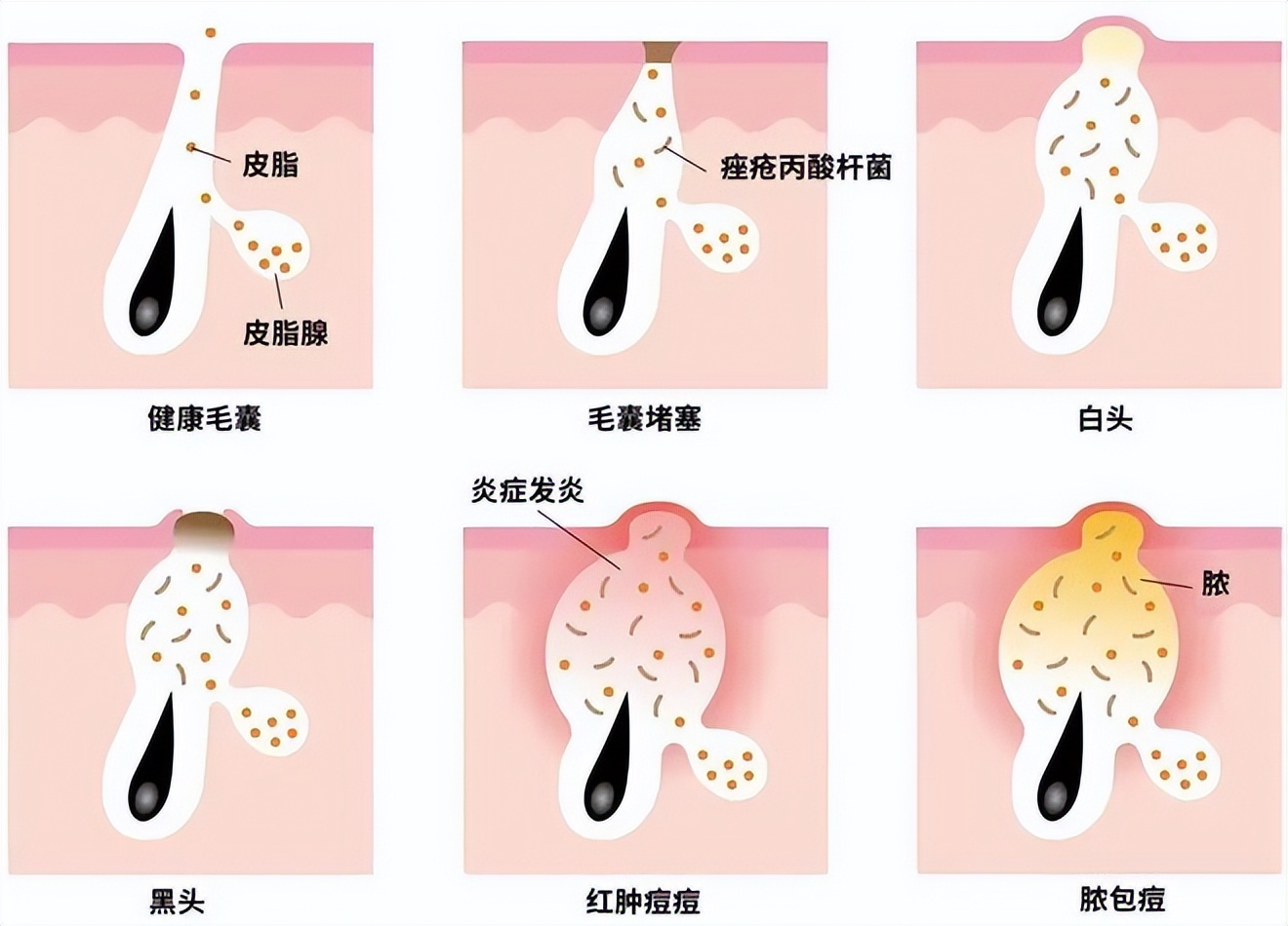 嘟嘟瓜美业网分享：​痘印总消不掉？你可能做错了这几件事！