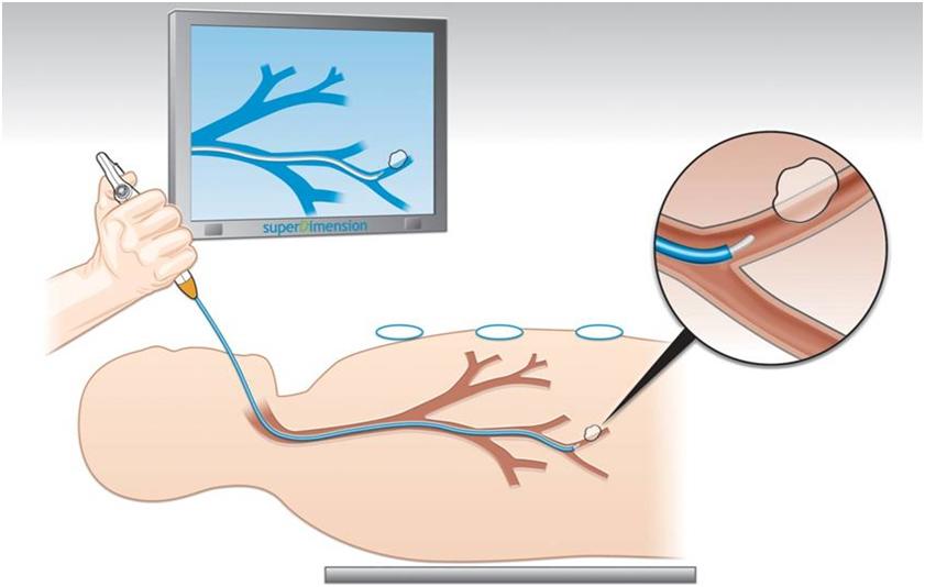 支气管扩张需要做鼻咽镜吗,支气管扩张咯血做支气管镜