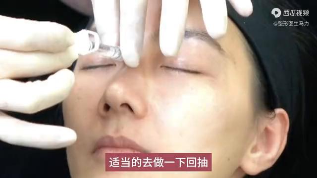 玻尿酸隆鼻填充山根,玻尿酸隆鼻怎么做听听专家的建议