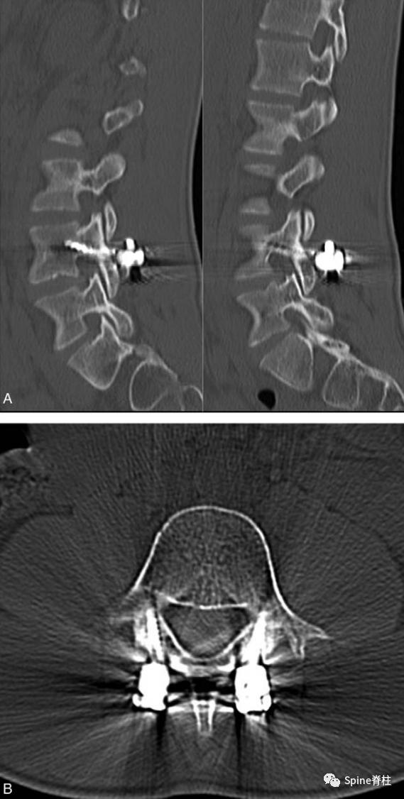 轻度峡部裂和重度峡部裂的区别,真性峡部裂和假性峡部裂