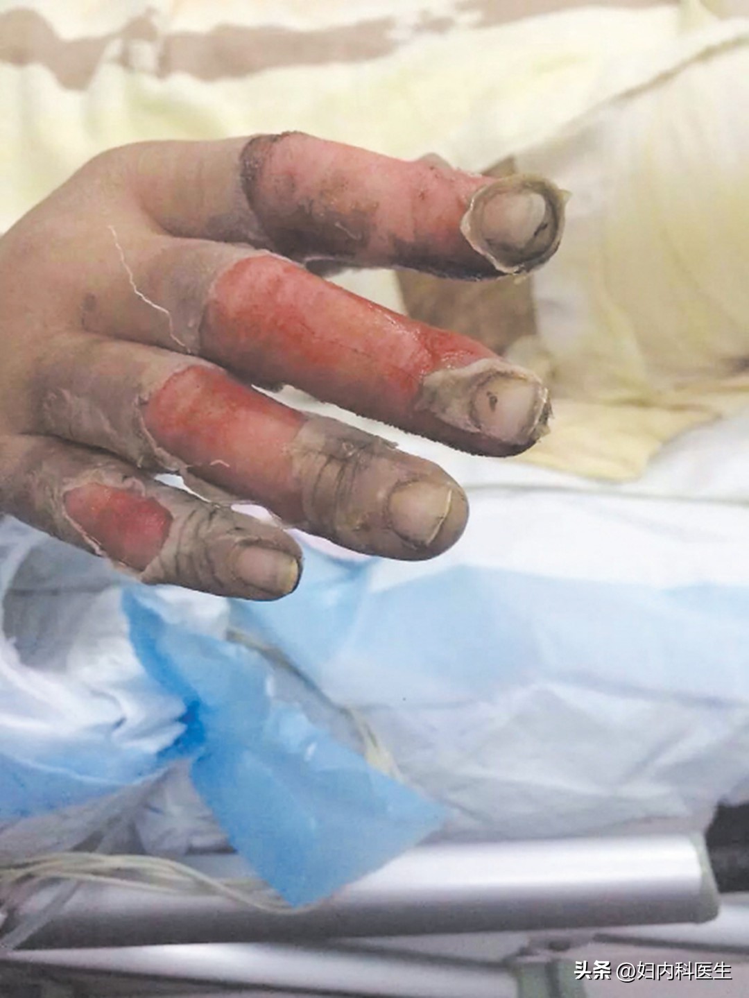 得了灰指甲不治疗会怎么样,灰指甲症状与治疗的费用大概多少