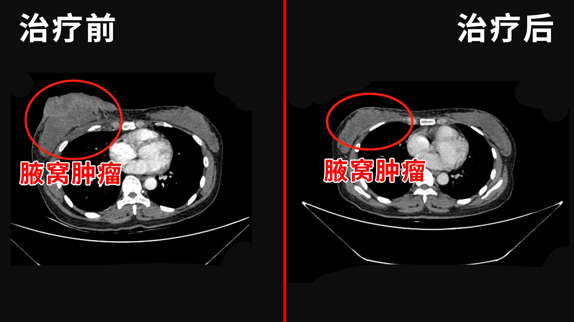 乳腺癌乳房破溃介入治疗,乳腺癌破溃后流脓能治愈吗