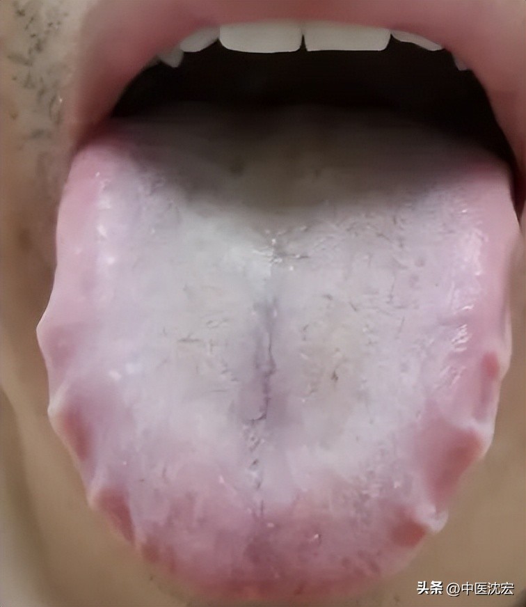 舌头偏红也有舌苔怎么调理,舌红舌胖有裂纹