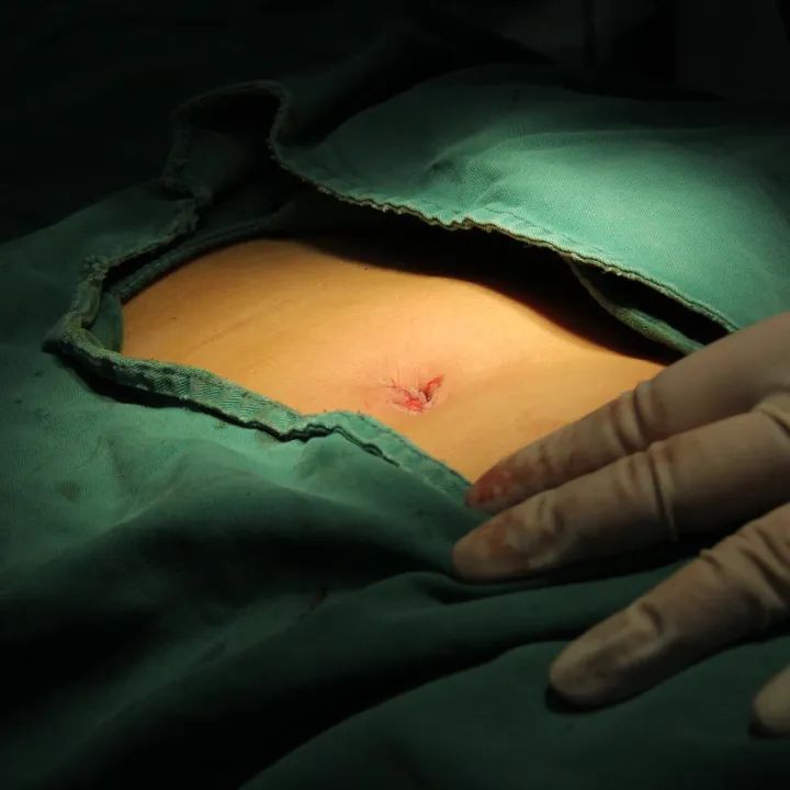 “术过无痕”，一个小孔解决孩子大问题