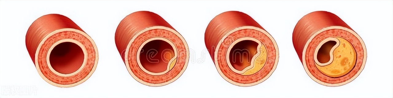 刚刚确诊冠心病怎么办,冠心病确诊后如何治疗