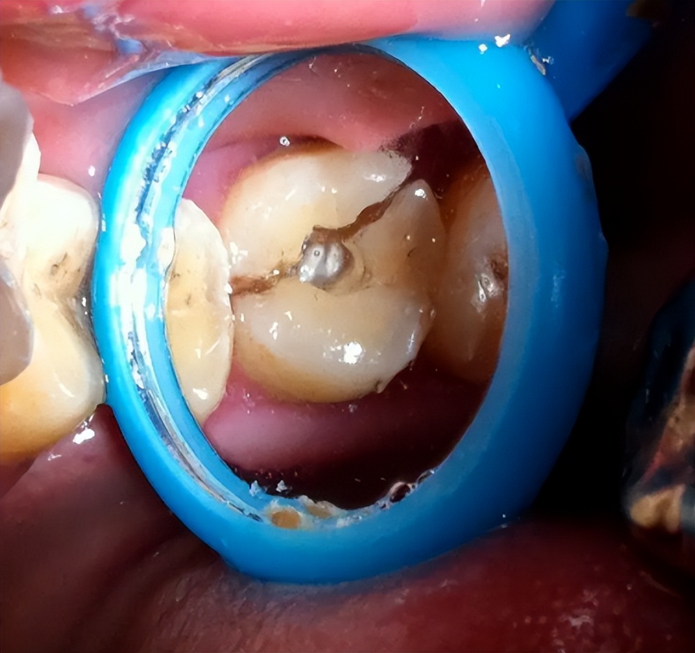 固定假牙一直发炎疼痛怎么办,为什么安了假牙后牙齿还是会痛