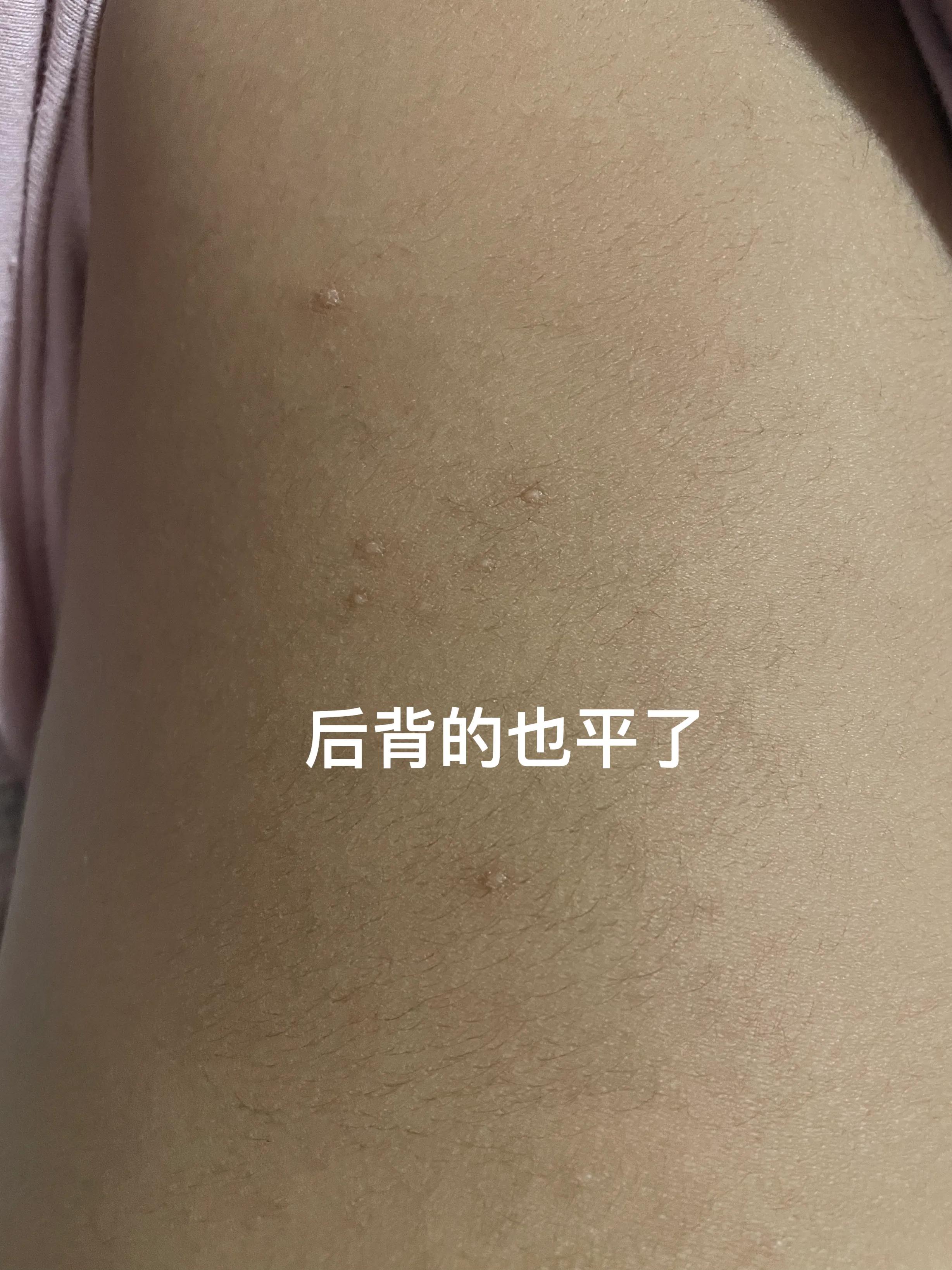 包皮传染性软疣自愈,传染性软疣多久可以自愈