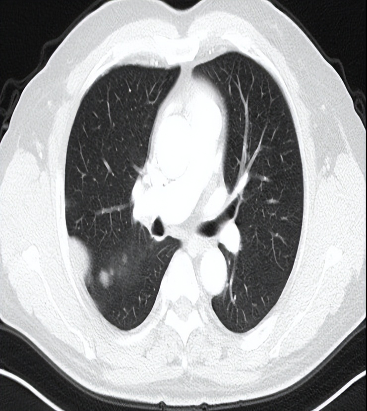 海南首例恶性胸膜间皮瘤,胸膜间皮瘤生存5年算治愈吗