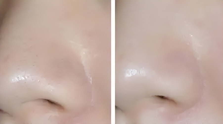 水杨酸缩毛孔的正确方法,皮秒缩毛孔恢复过程图